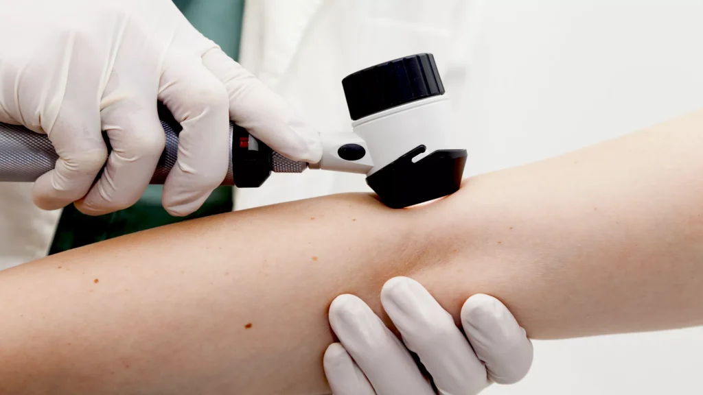 Skin Biopsy