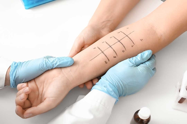 Allergy Testing